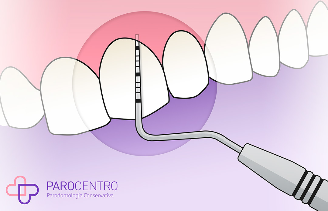 parodontite e sua diagnosi, Parocentro