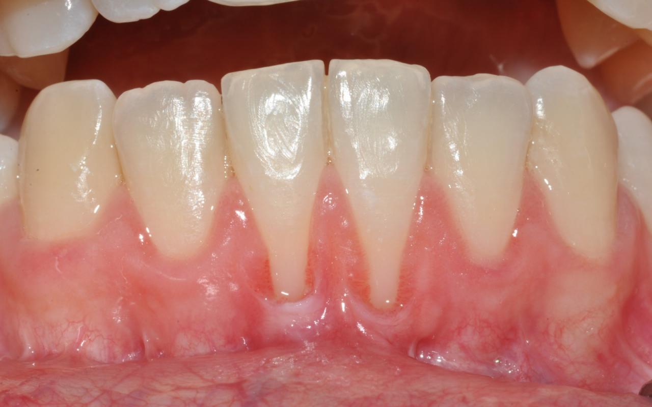 colletti denti