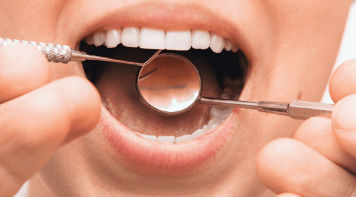 Parodontite: cause, sintomi e rimedi